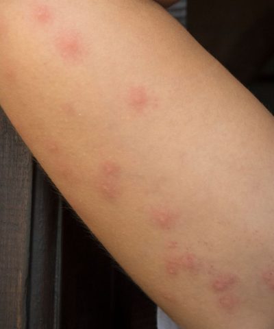 bedbug-bed-bug-bites-exterminator-columbia-sc Close-up of a person’s forearm with multiple red, raised bumps, possibly insect bites or an allergic reaction, beside a wooden surface.