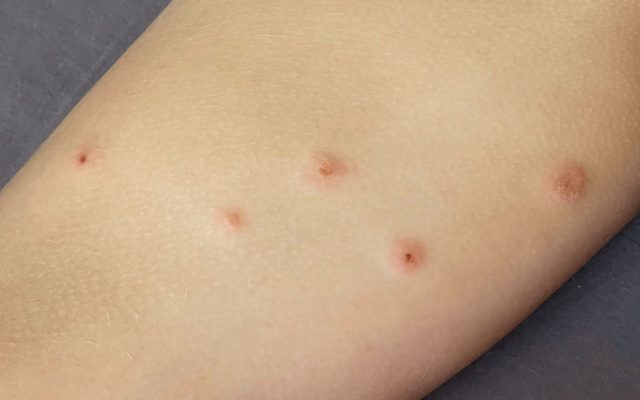 Close-up of human skin with five evenly spaced red bumps, possibly insect bites, showing central punctures and mild irritation.