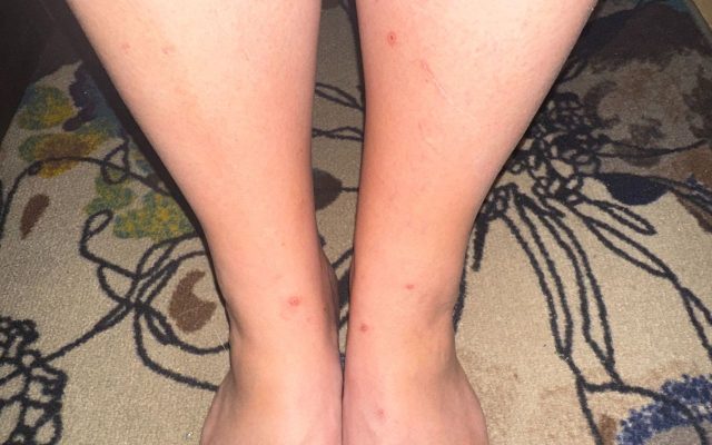 fleas-flea-infestation-bites-rash-exterminator-midlands-sc Close-up of lower legs and feet on floral-patterned carpet, showing multiple small red marks or bumps on skin from flea bites.